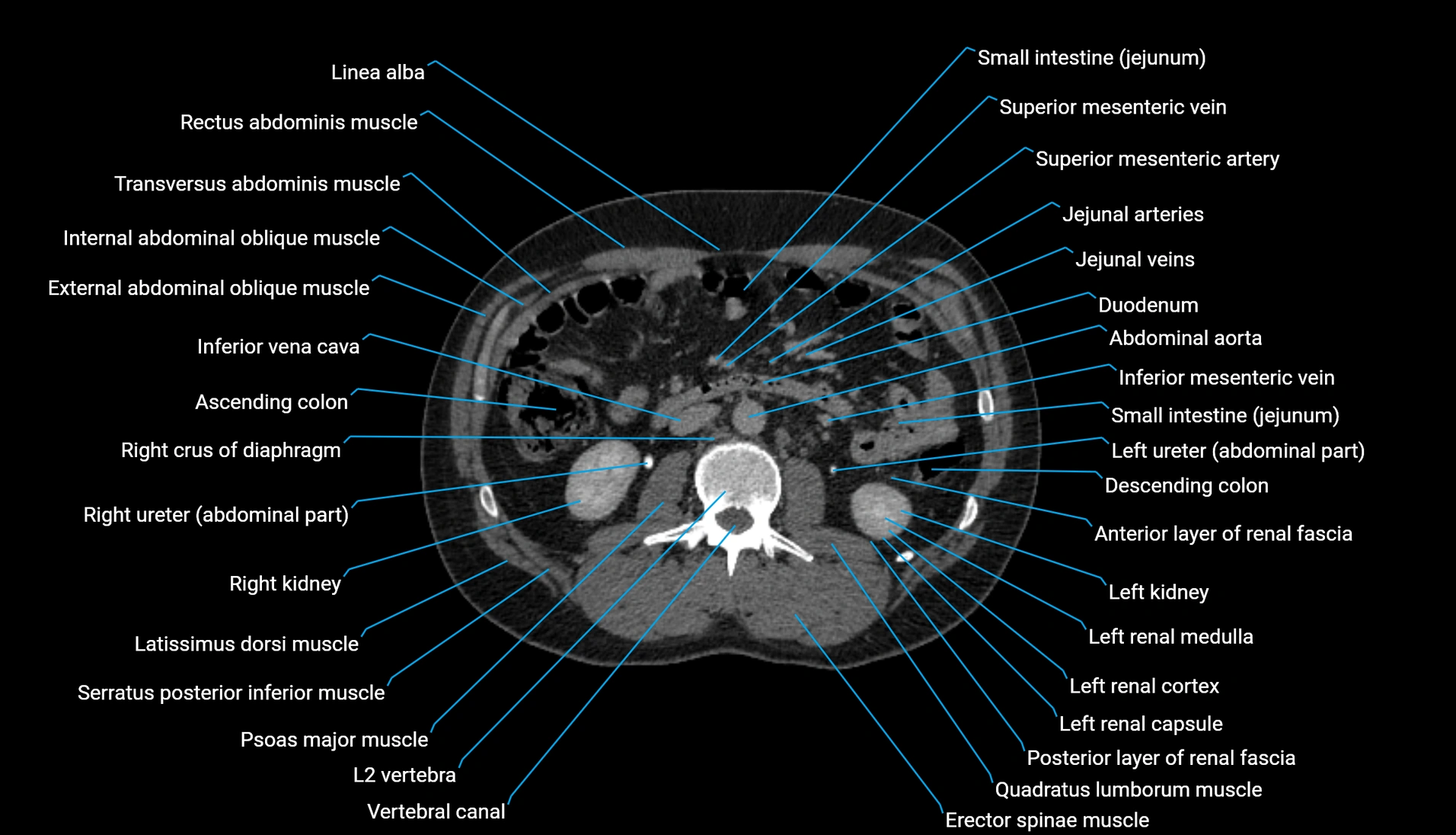 CT urogram axial cross sectional anatomy  labelled radiology image-00117.webp